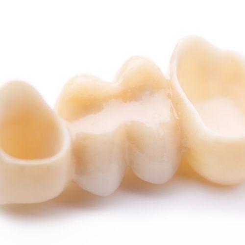 Coronas dentales de cerámica