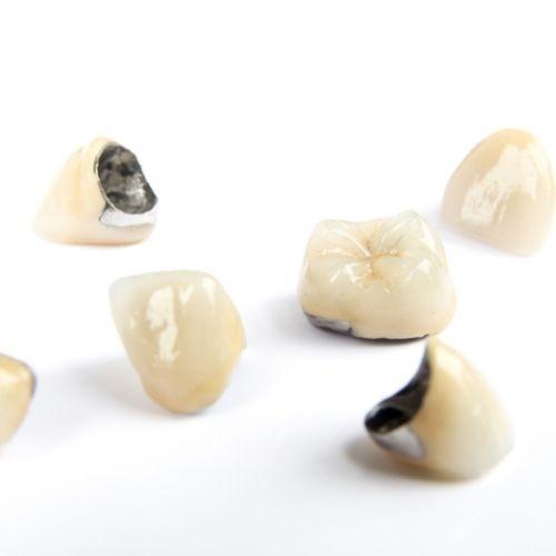 Coronas dentales de porcelana y metal